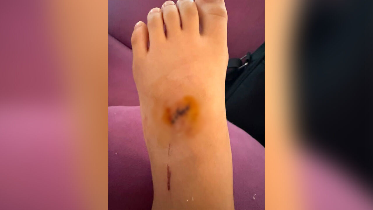 Alanya tatilinde 9 yaşındaki Kazak çocuk yaralandı: Aile otelden şikayetçi